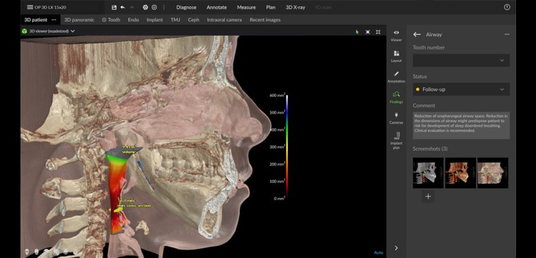 DEXIS DVT Scan Atemwege