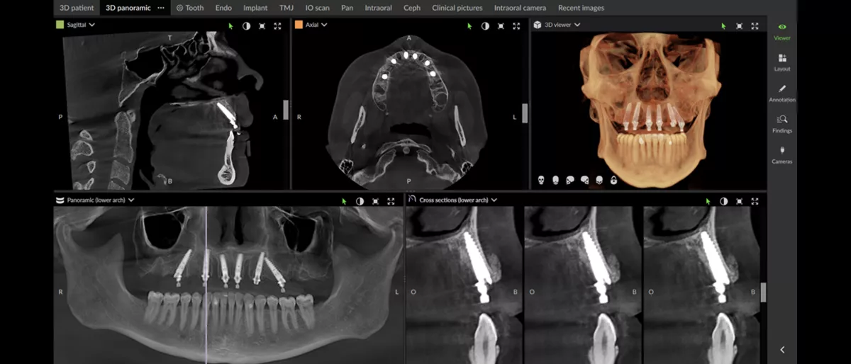 DEXIS DVT Scan für MAR - Enhanced Visibility