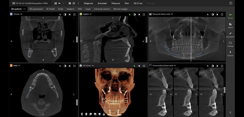 DEXIS DVT Scan für MKG Operationsplanung