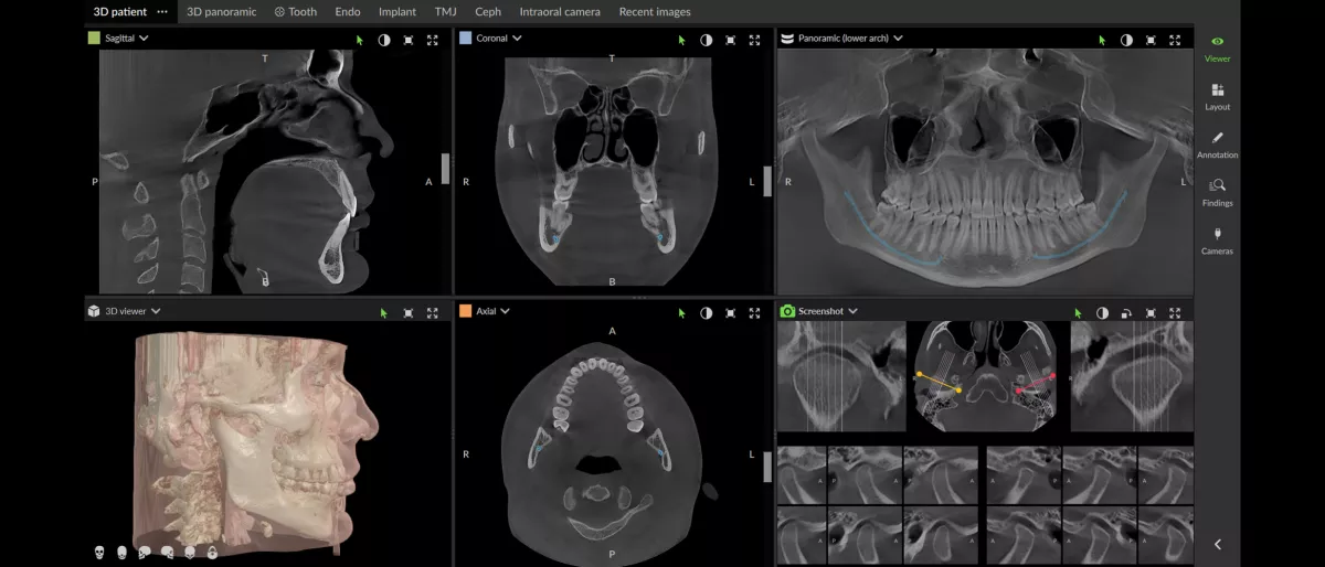 DEXIS DVT Moderne Technologien Stitch-free scan